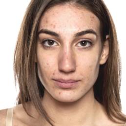 Acne Hydroluxx Facial