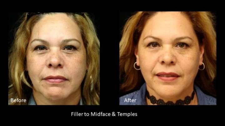 Fillers - B&A-1