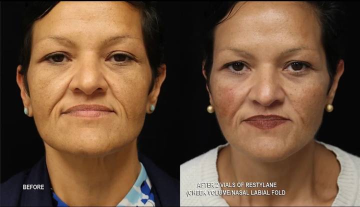 Fillers - B&A-10