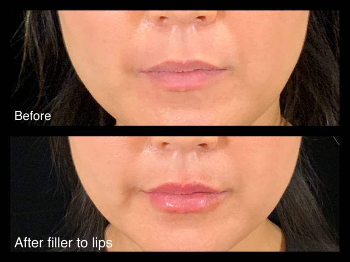 Fillers - B&A-11