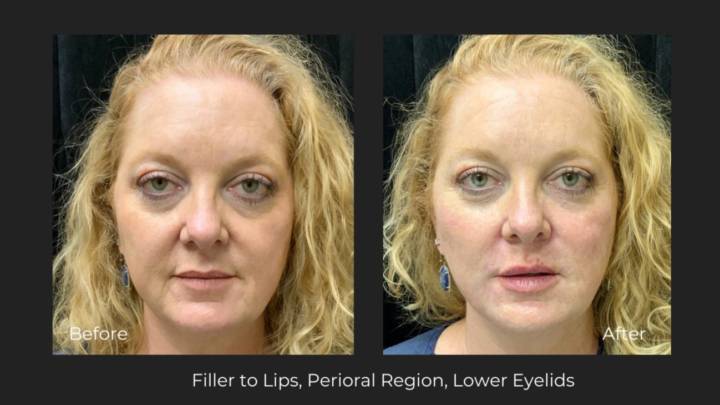 Fillers - B&A-12