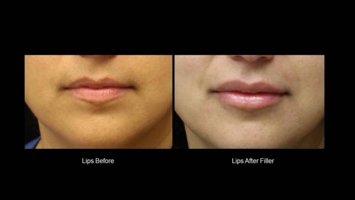 Fillers - B&A-2
