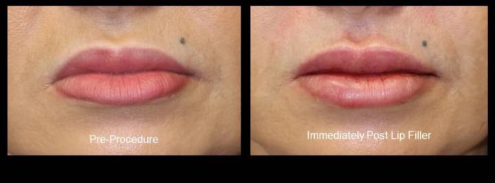 Fillers - B&A-3