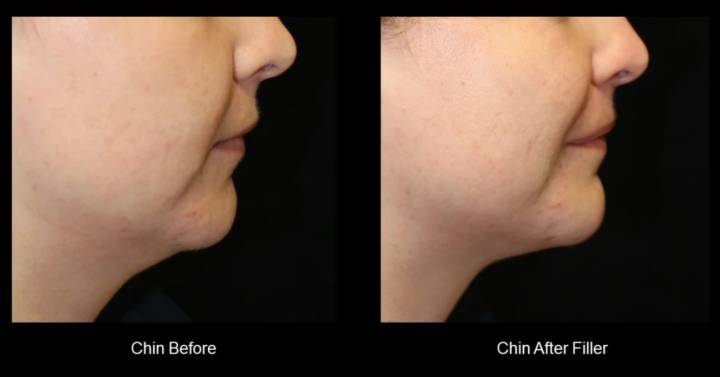 Fillers-B&A-4