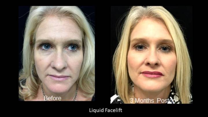 Fillers-B&A-5