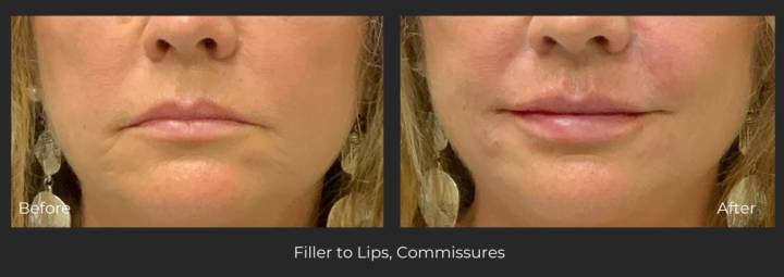 Fillers - B&A-6