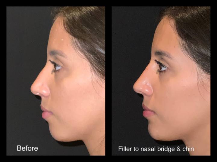 Fillers - B&A-7