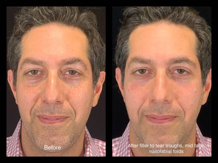 Fillers - B&A-8