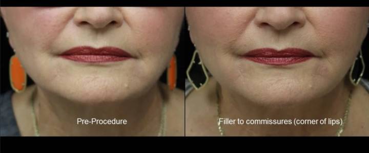 Fillers - B&A-9