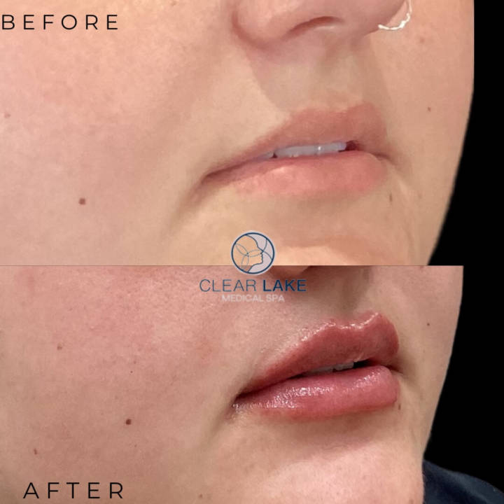 B&A1 - Lip Filler